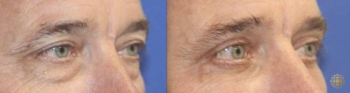 Before & After Blepharoplasty Case 261 View #3 View in Newport Beach, CA