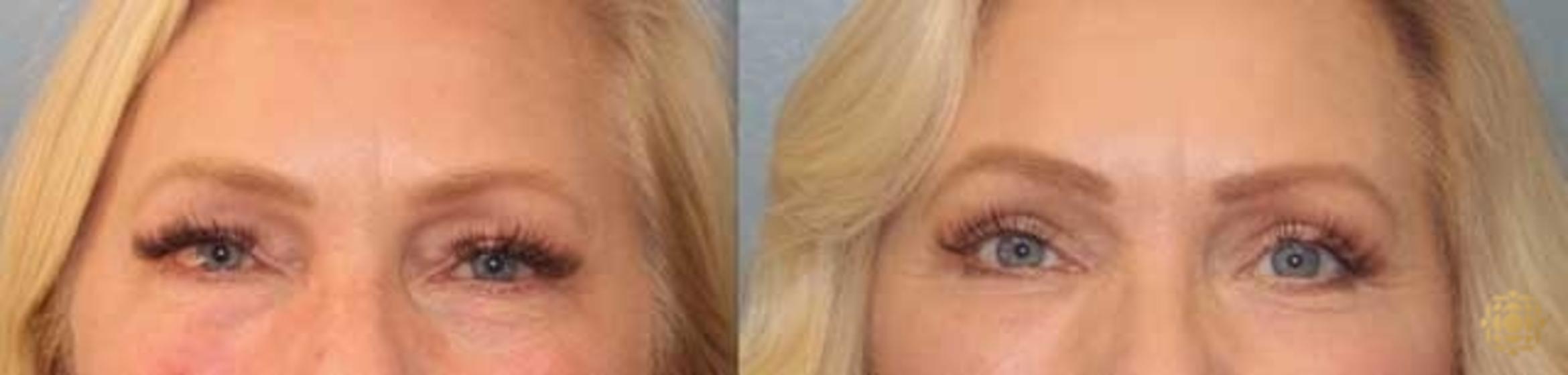 Before & After Blepharoplasty Case 29 Front View in Newport Beach, CA