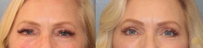 Before & After Blepharoplasty Case 29 Front View in Newport Beach, CA