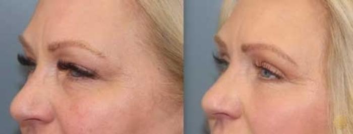 Before & After Blepharoplasty Case 29 Left Oblique View in Newport Beach, CA
