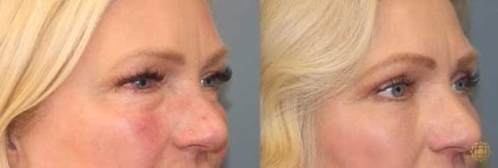 Before & After Blepharoplasty Case 29 Right Oblique View in Newport Beach, CA
