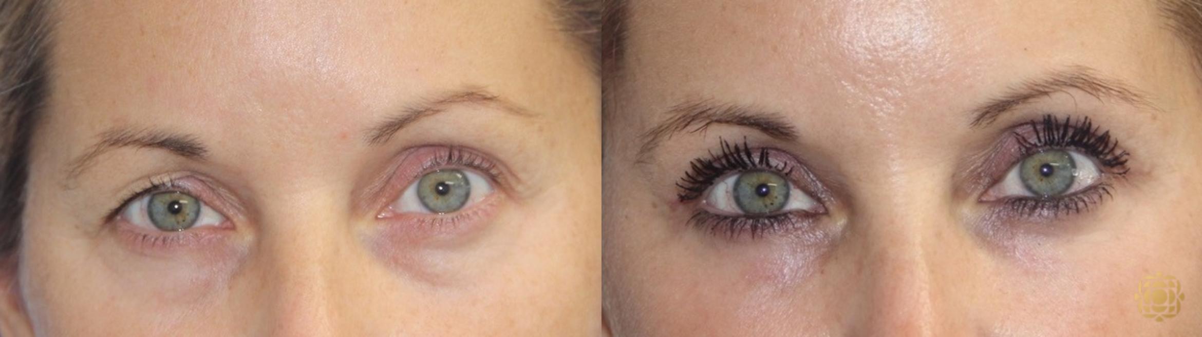 Before & After Blepharoplasty Case 409 Front View in Newport Beach, CA