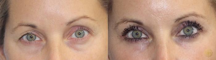 Before & After Blepharoplasty Case 409 Front View in Newport Beach, CA