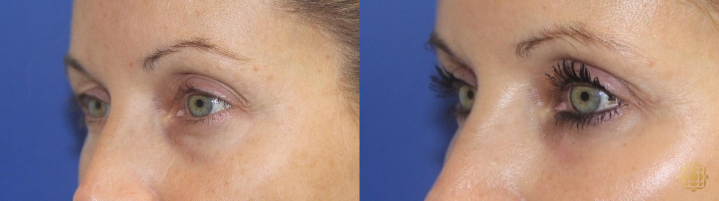 Before & After Blepharoplasty Case 409 Left Oblique View in Newport Beach, CA