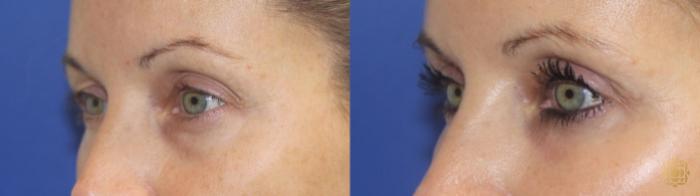 Before & After Blepharoplasty Case 409 Left Oblique View in Newport Beach, CA