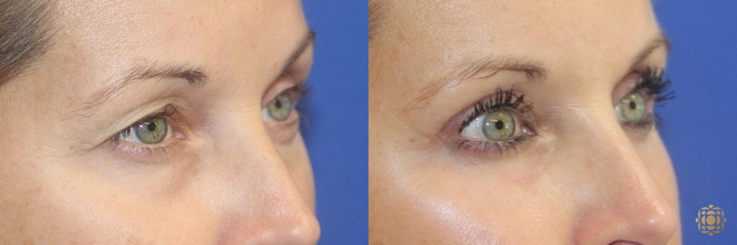 Before & After Blepharoplasty Case 409 Right Oblique View in Newport Beach, CA