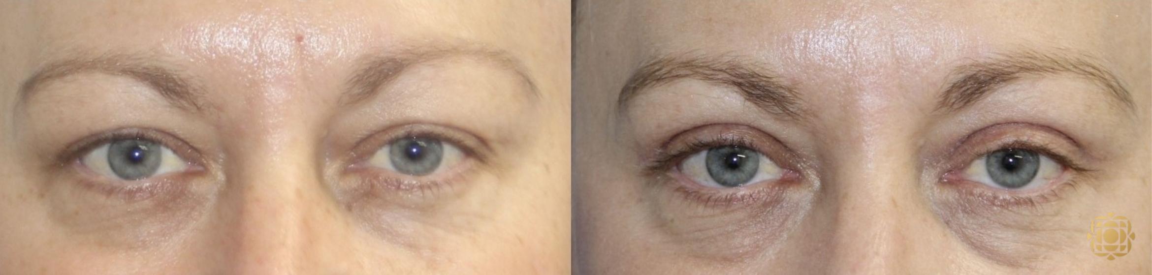 Before & After Blepharoplasty Case 412 Front View in Newport Beach, CA