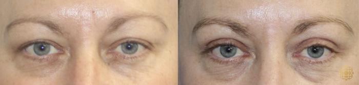 Before & After Blepharoplasty Case 412 Front View in Newport Beach, CA