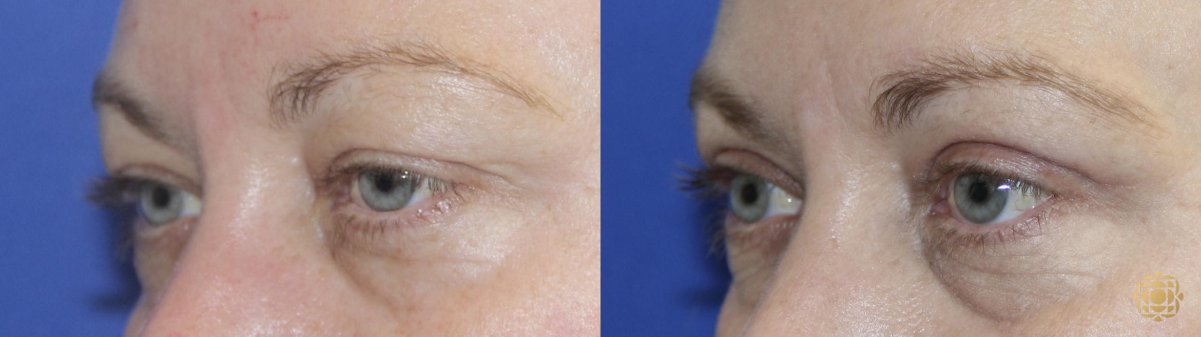 Before & After Blepharoplasty Case 412 Left Side View in Newport Beach, CA