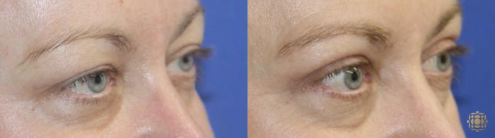 Before & After Blepharoplasty Case 412 Right Side View in Newport Beach, CA
