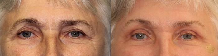 Before & After Brow Lift Case 1 View #1 View in Newport Beach, CA