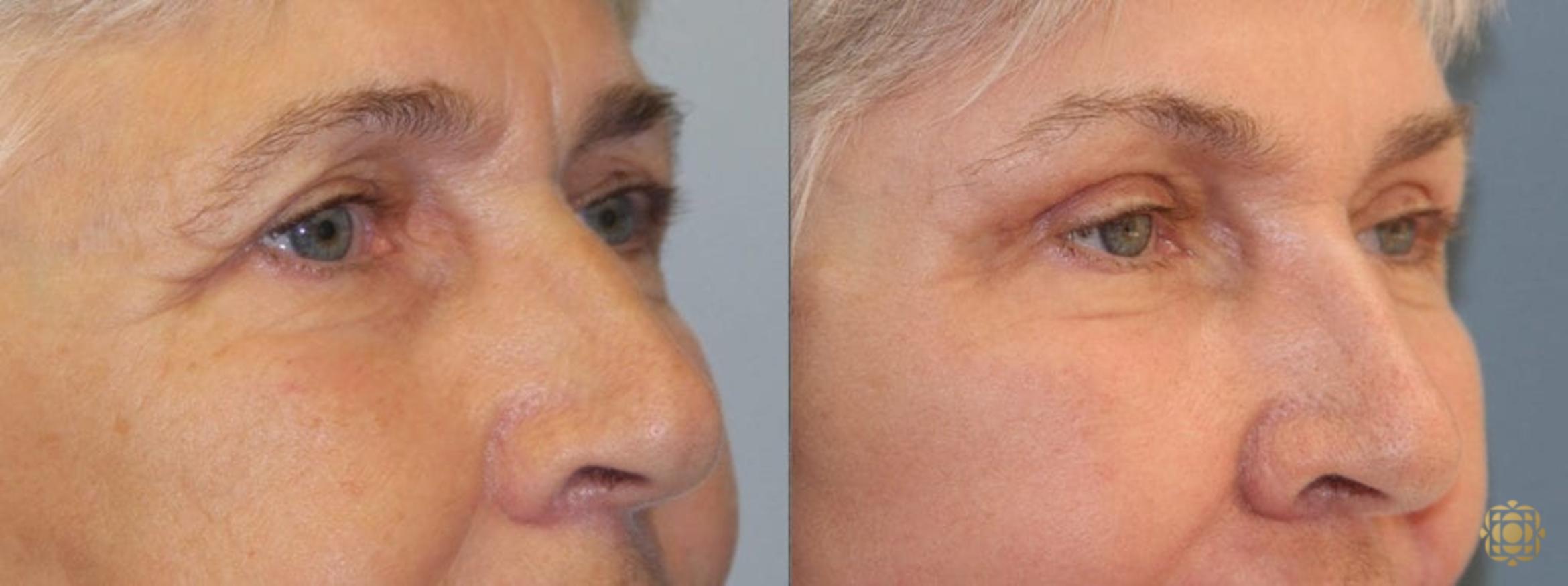 Before & After Brow Lift Case 1 View #2 View in Newport Beach, CA