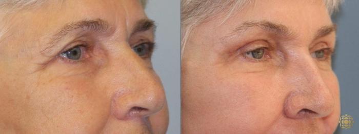 Before & After Brow Lift Case 1 View #2 View in Newport Beach, CA