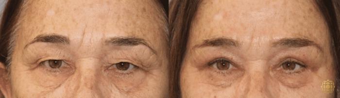 Before & After Brow Lift Case 11 Front View in Newport Beach, CA
