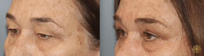 Before & After Brow Lift Case 11 Left Side View in Newport Beach, CA