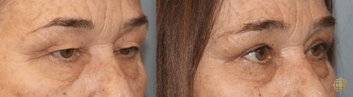 Before & After Brow Lift Case 11 Right Side View in Newport Beach, CA
