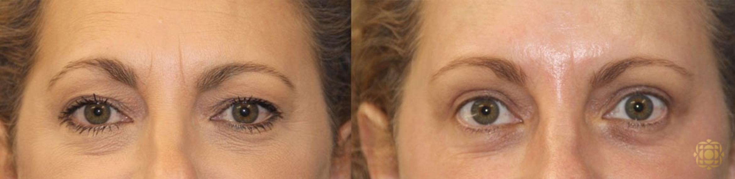 Before & After Brow Lift Case 14 Front View in Newport Beach, CA