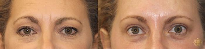 Before & After Brow Lift Case 14 Front View in Newport Beach, CA