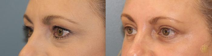 Before & After Brow Lift Case 14 Left Side View in Newport Beach, CA