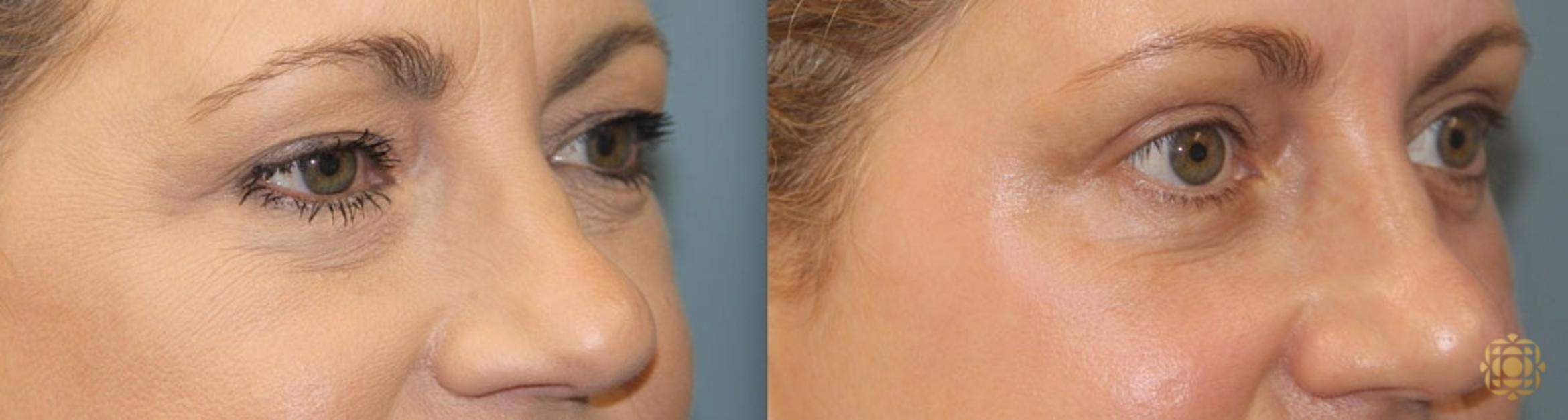 Before & After Brow Lift Case 14 Right Side View in Newport Beach, CA