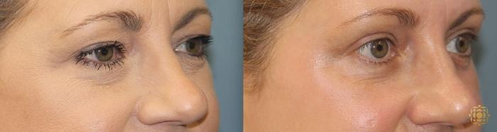 Before & After Brow Lift Case 14 Right Side View in Newport Beach, CA