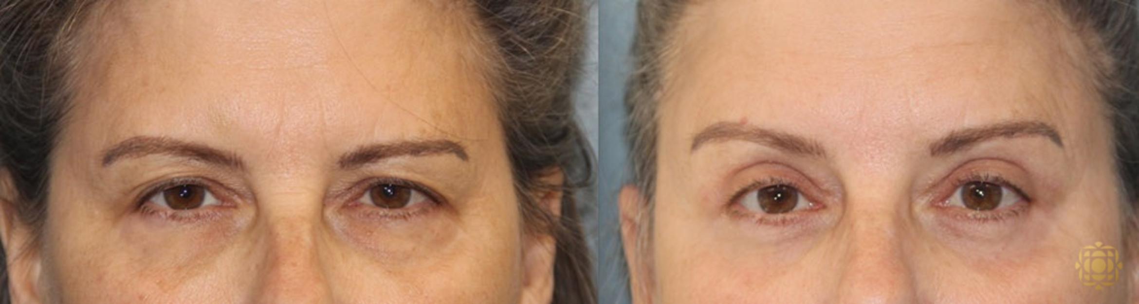Before & After Brow Lift Case 17 View #1 View in Newport Beach, CA