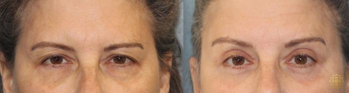 Before & After Brow Lift Case 17 View #1 View in Newport Beach, CA