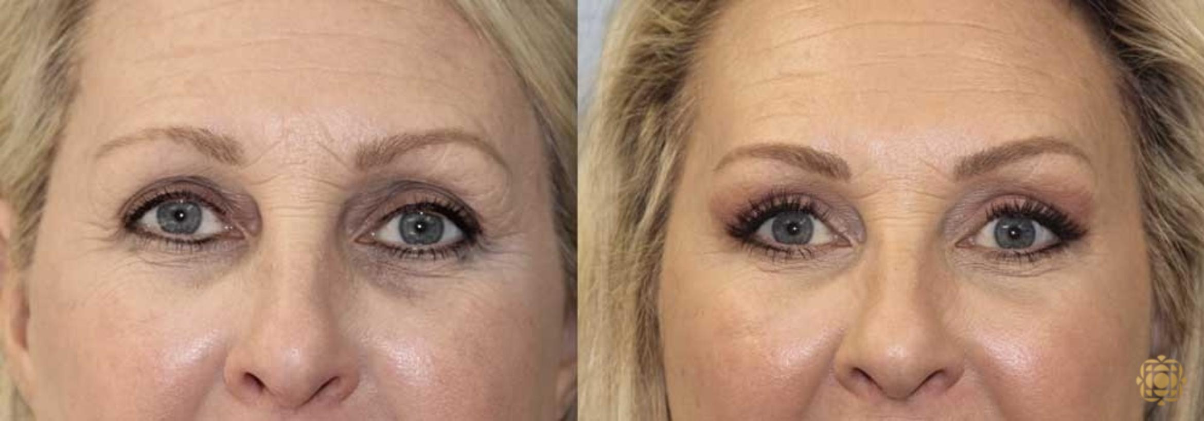 Before & After Brow Lift Case 18 Front View in Newport Beach, CA