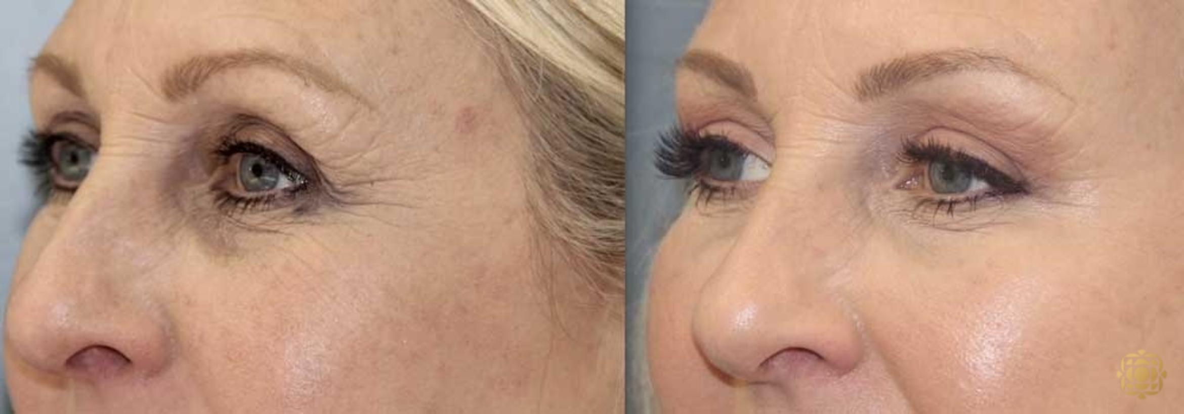 Before & After Brow Lift Case 18 Left Side View in Newport Beach, CA