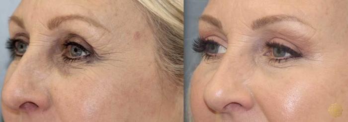 Before & After Brow Lift Case 18 Left Side View in Newport Beach, CA