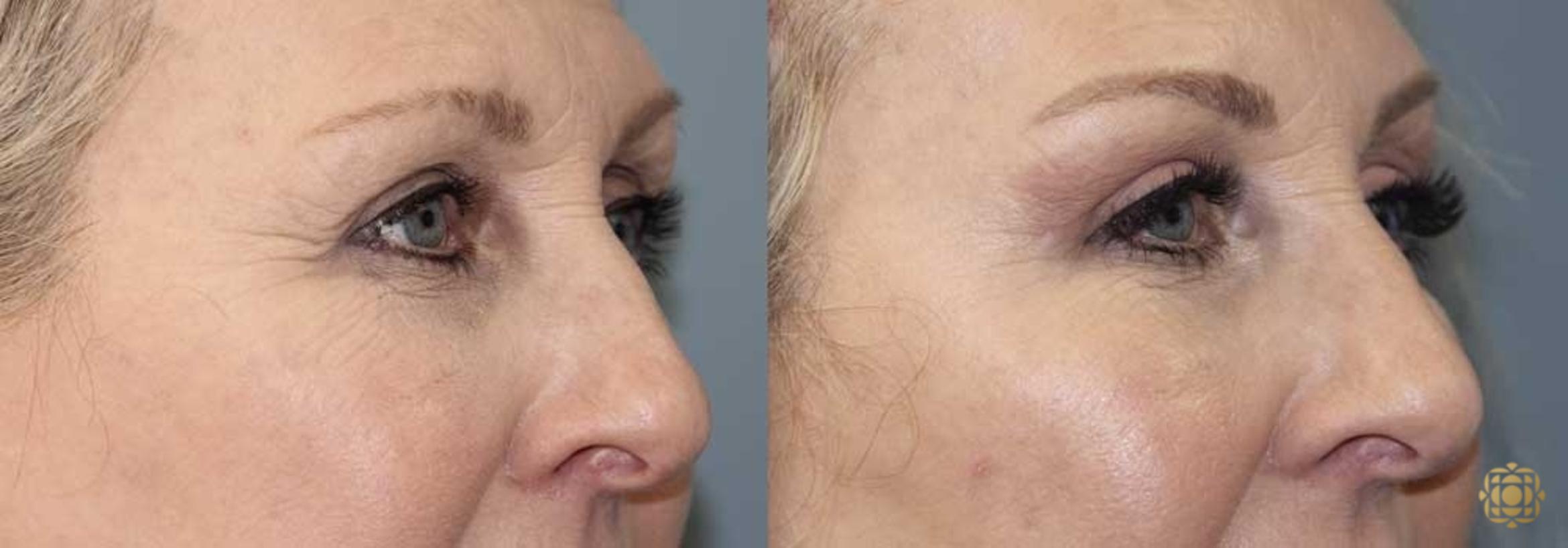 Before & After Brow Lift Case 18 Right Side View in Newport Beach, CA