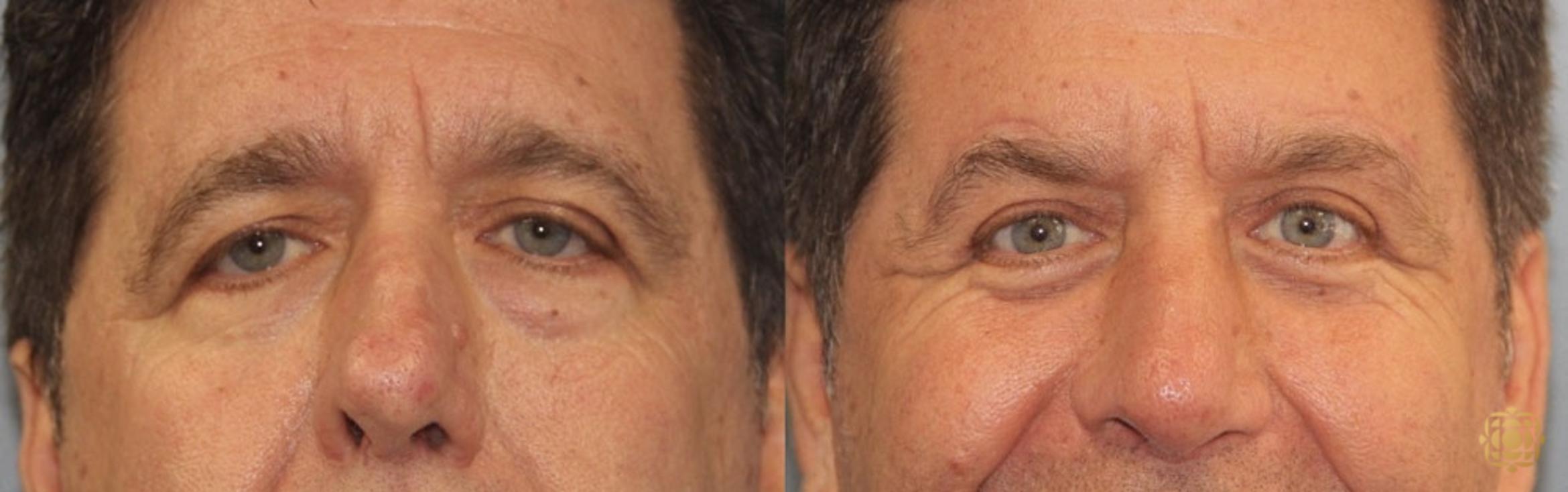 Before & After Brow Lift Case 22 Front View in Newport Beach, CA