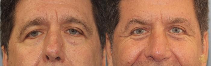 Before & After Brow Lift Case 22 Front View in Newport Beach, CA