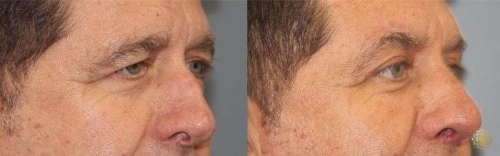 Before & After Brow Lift Case 22 Right Oblique View in Newport Beach, CA