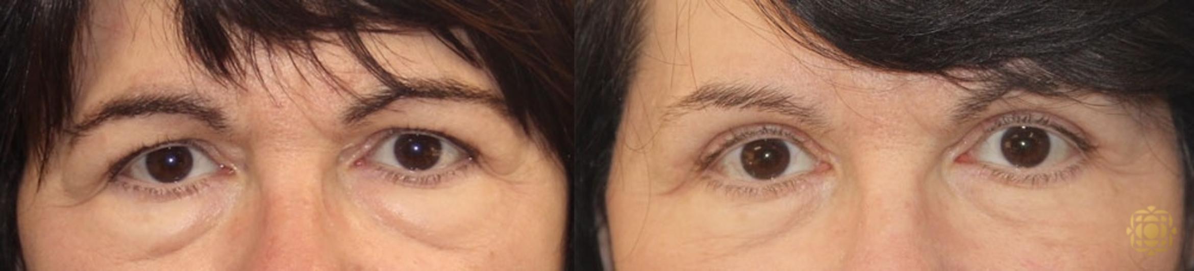Before & After Blepharoplasty Case 25 Front View in Newport Beach, CA