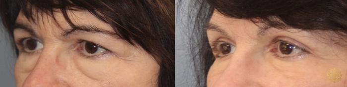 Before & After Blepharoplasty Case 25 Left Side View in Newport Beach, CA