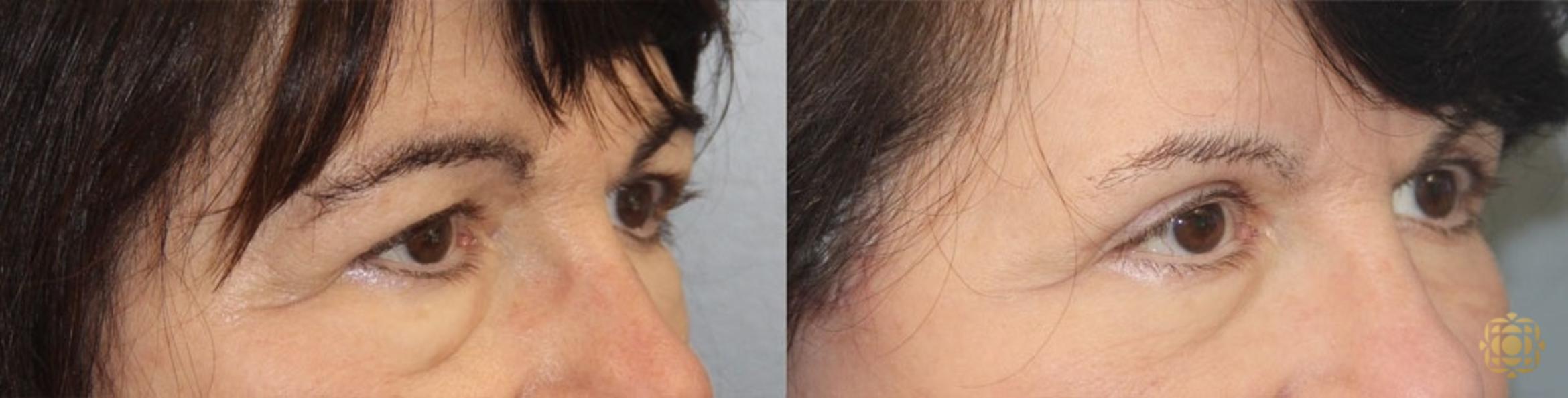 Before & After Blepharoplasty Case 25 Right Side View in Newport Beach, CA