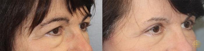 Before & After Blepharoplasty Case 25 Right Side View in Newport Beach, CA