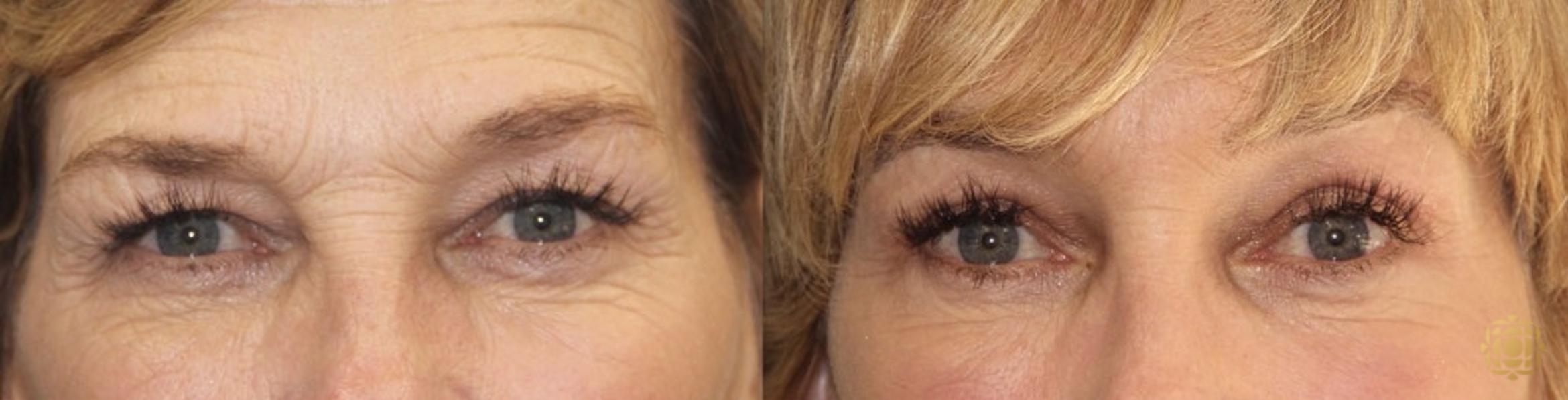 Before & After Brow Lift Case 26 Front View in Newport Beach, CA