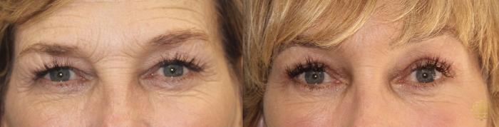 Before & After Brow Lift Case 26 Front View in Newport Beach, CA