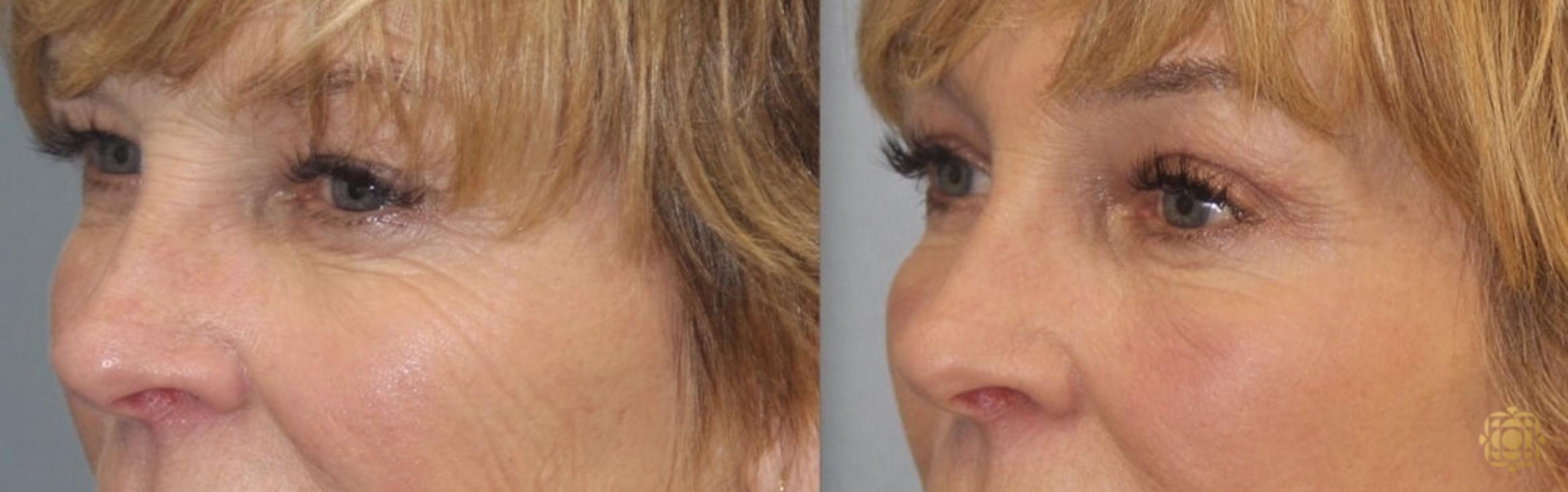 Before & After Brow Lift Case 26 Left Oblique View in Newport Beach, CA