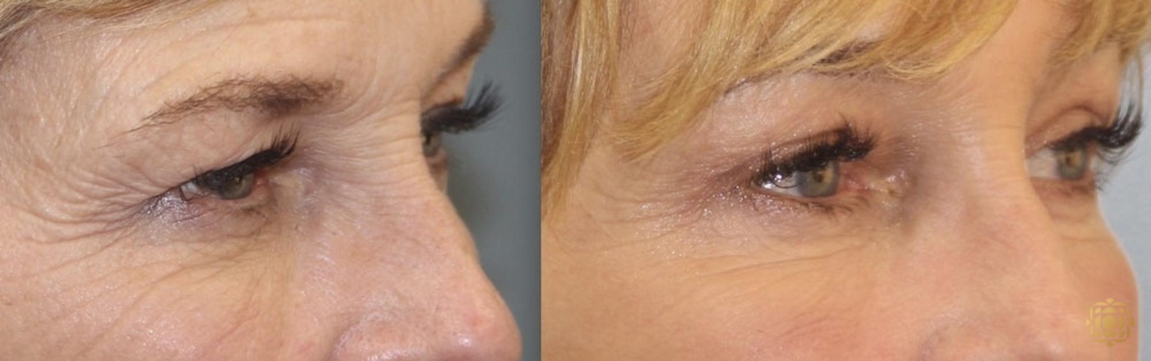 Before & After Brow Lift Case 26 Right Oblique View in Newport Beach, CA