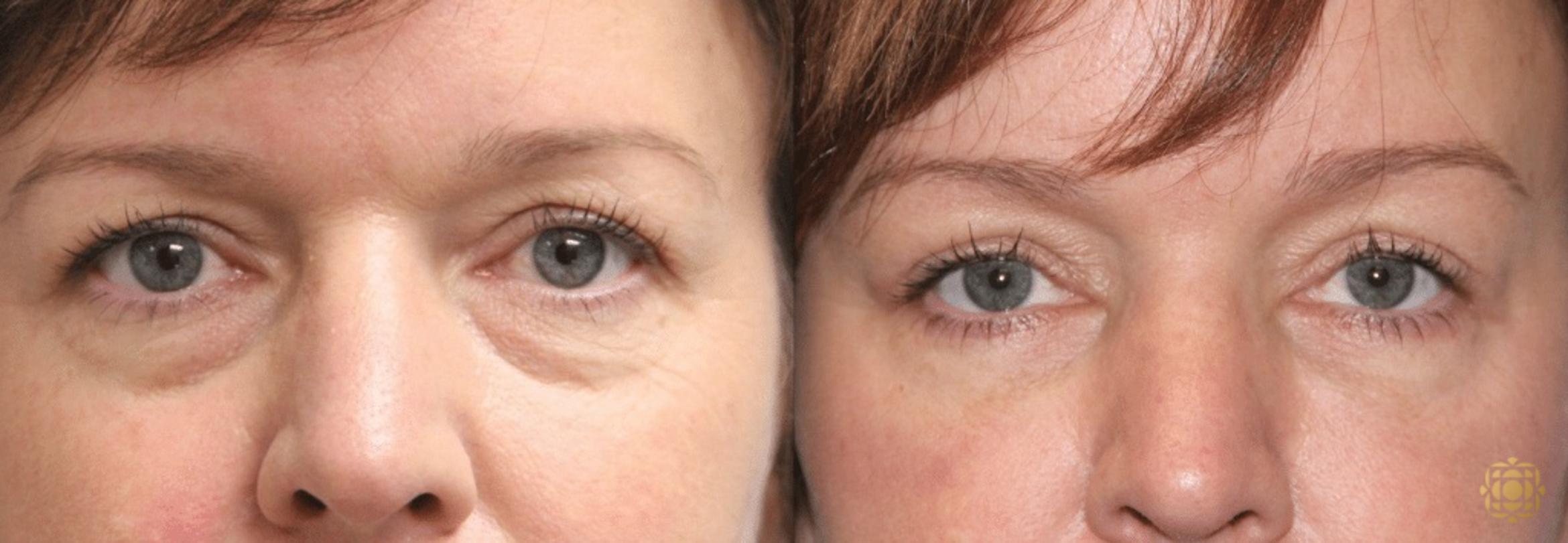 Before & After Brow Lift Case 3 View #1 View in Newport Beach, CA