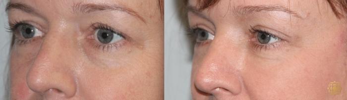 Before & After Brow Lift Case 3 View #2 View in Newport Beach, CA