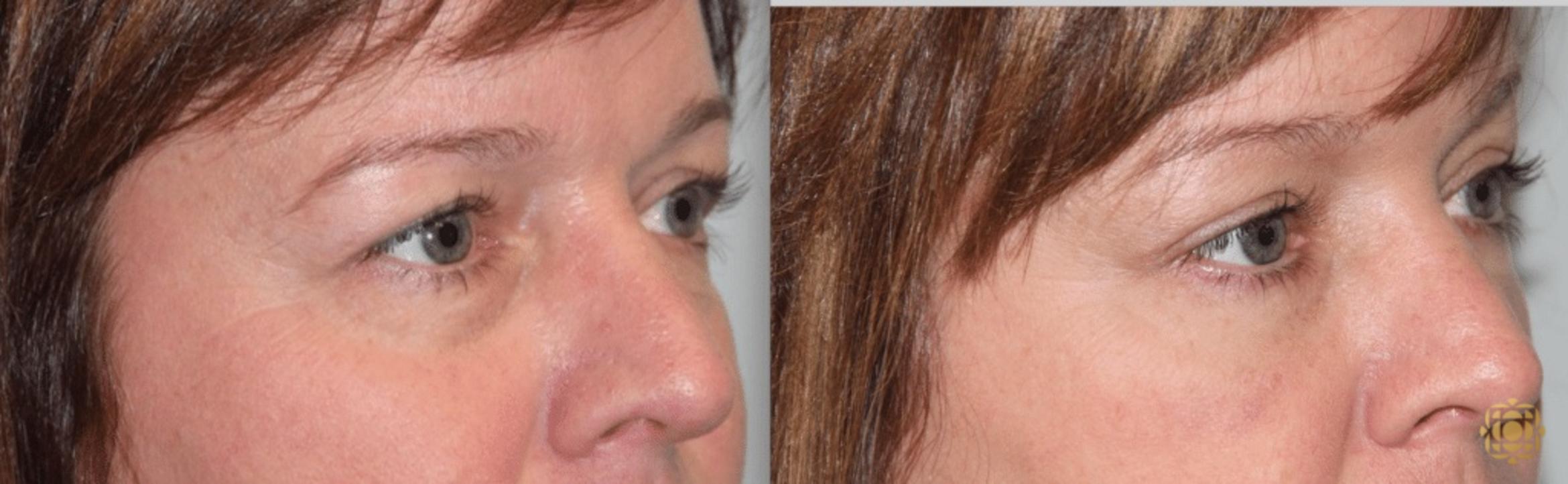 Before & After Brow Lift Case 3 View #3 View in Newport Beach, CA