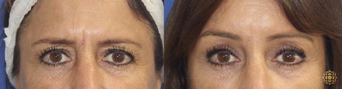 Before & After Brow Lift Case 32 Front View in Newport Beach, CA