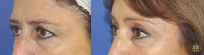 Before & After Brow Lift Case 32 Left Oblique View in Newport Beach, CA