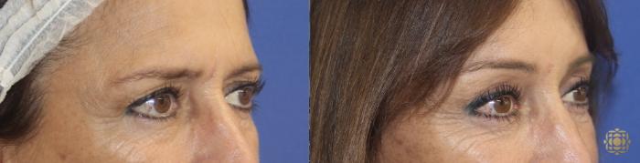 Before & After Brow Lift Case 32 Right Oblique View in Newport Beach, CA