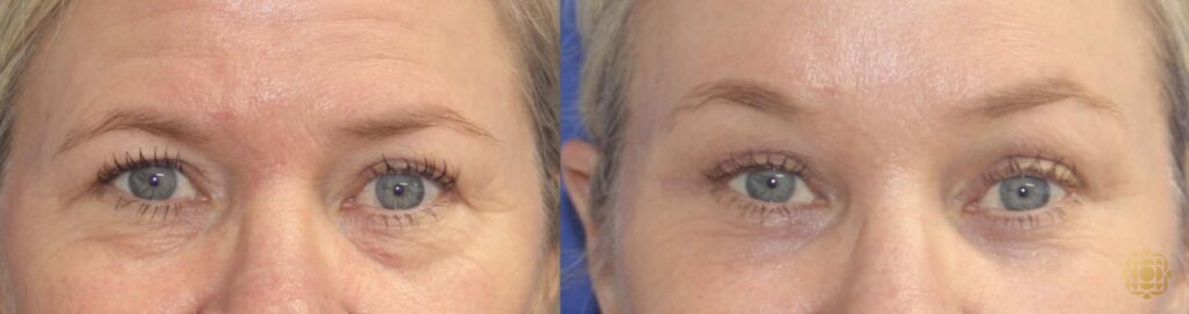 Before & After Brow Lift Case 37 Front View in Newport Beach, CA
