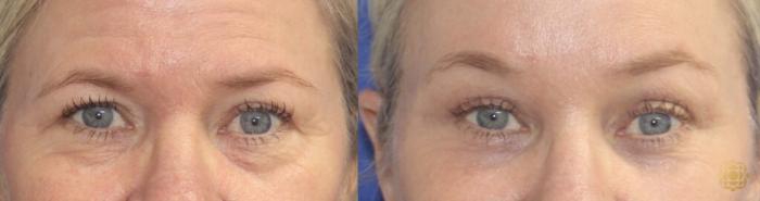 Before & After Brow Lift Case 37 Front View in Newport Beach, CA